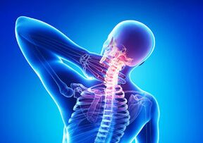 Mga palatandaan ng cervical osteochondrosis