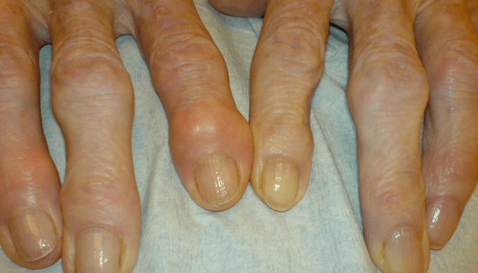 Sakit sa mga kasukasuan ng mga daliri na may osteoarthritis