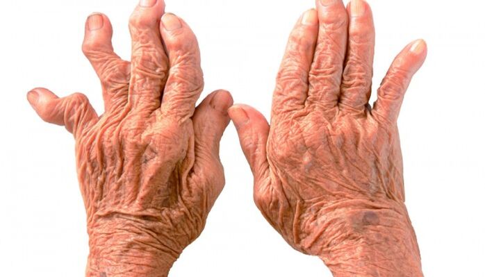 rheumatoid arthritis bilang isang sanhi ng sakit sa mga kasukasuan ng mga daliri