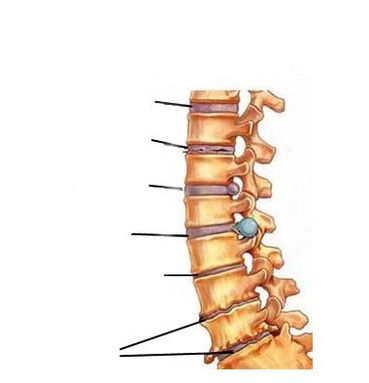 Mga yugto ng pag-unlad ng osteochondrosis