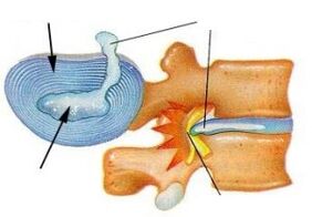 pagkasira ng fibrous ring sa cervical osteochondrosis