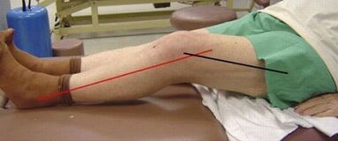 Ang progresibong arthrosis ng kasukasuan ng tuhod