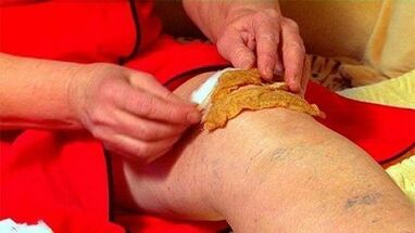 Compresses para sa arthrosis ng kasukasuan ng tuhod