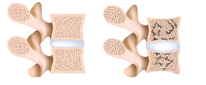 osteoporosis - ang pagtanggal ng calcium sa mga buto