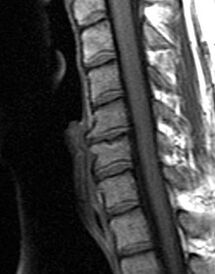radiography ng thoracic spine