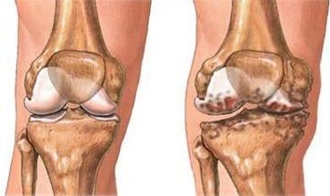 Arthrosis ng tuhod