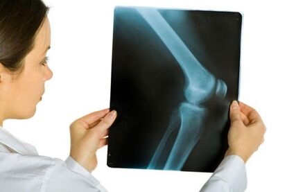 Paggamot ng arthrosis ng kasukasuan ng tuhod