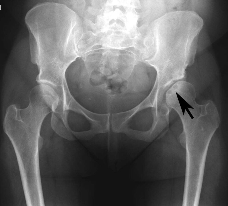 Deposition ng calcium salts sa hip joint na may pseudogout sa x-ray