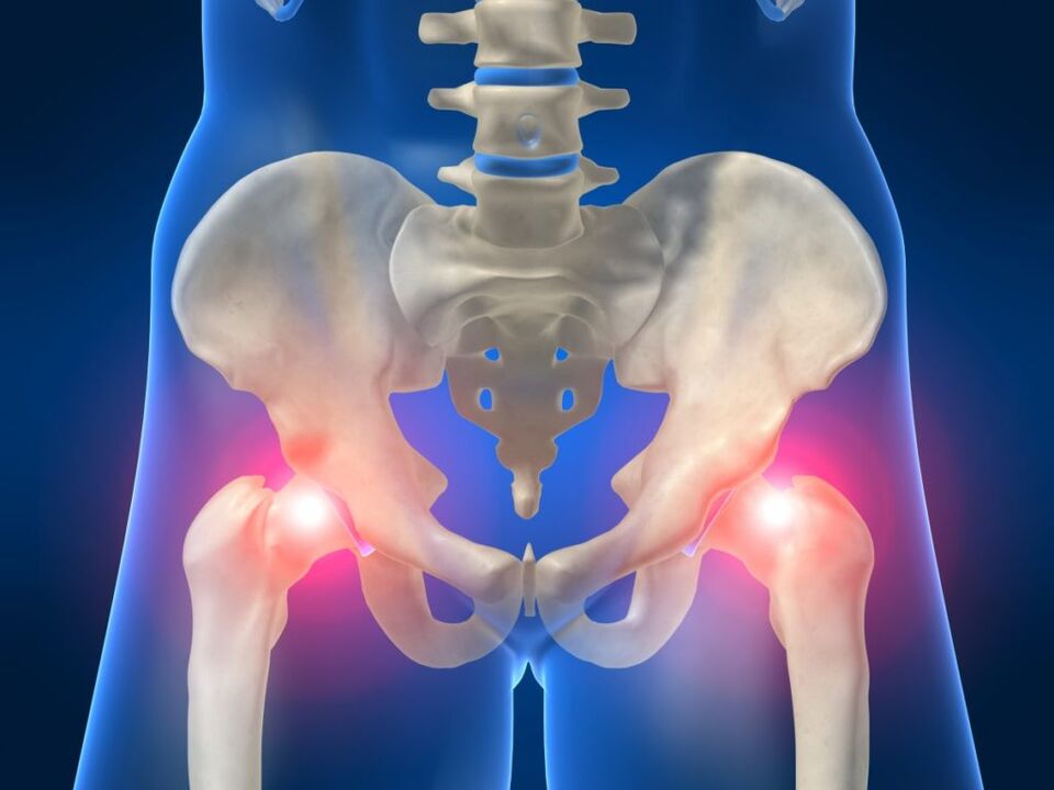 Sa ankylosing spondylitis, ang bilateral pain sa hip joint ay nakakagambala