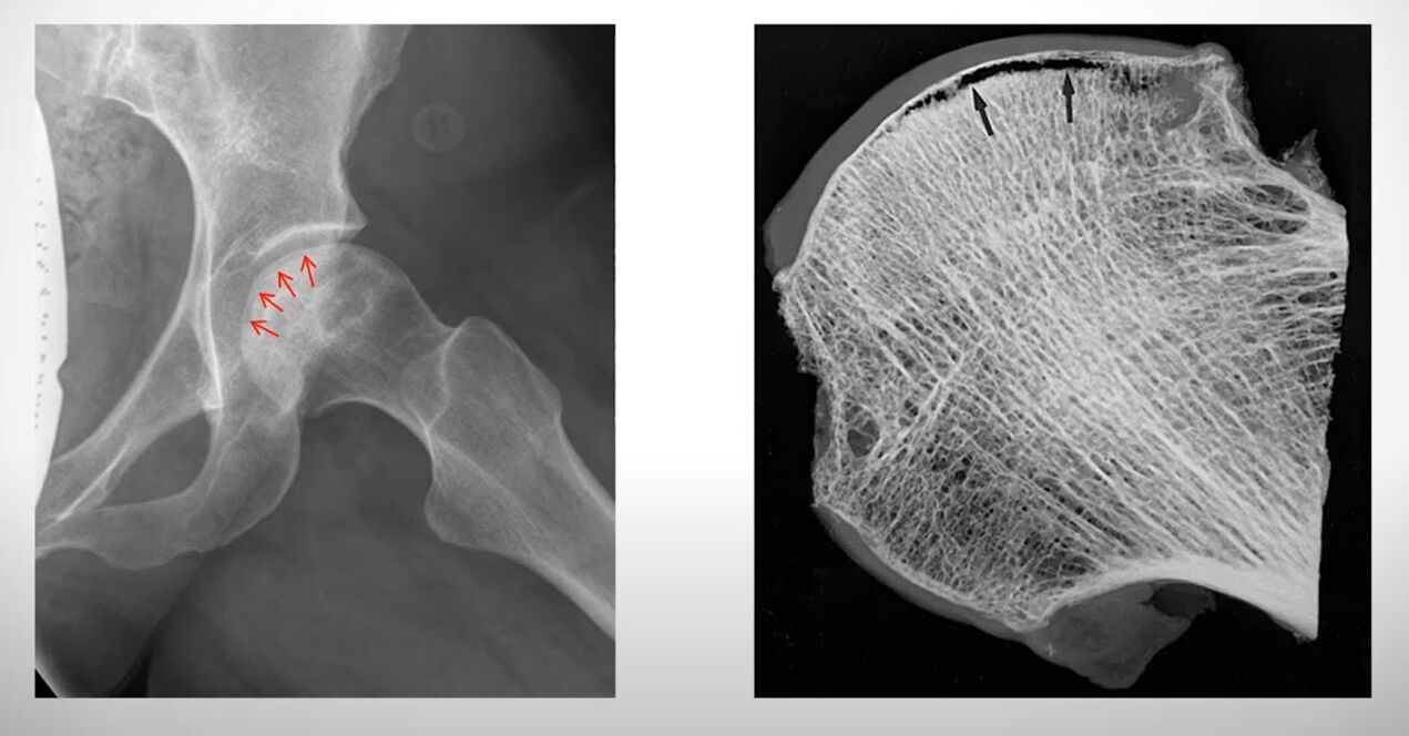 X-ray ng femoral head na apektado ng aseptic necrosis
