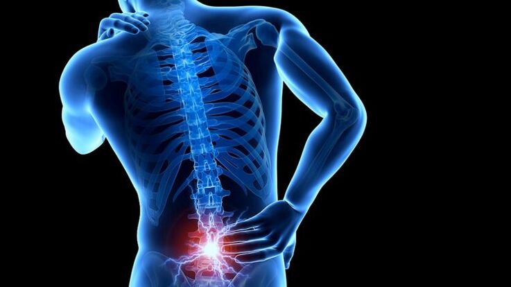 sakit sa likod na may lumbar osteochondrosis